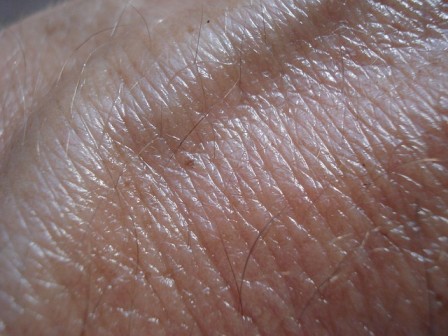 skin cancer treatment cost in india